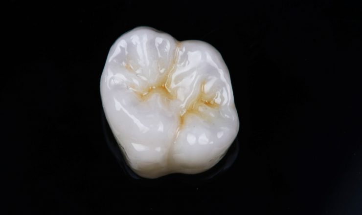 セラミッククラウン