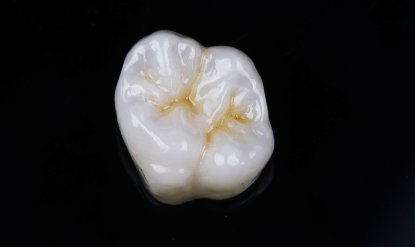 セラミッククラウン